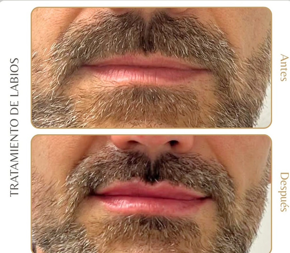 Antes/después labios hombre