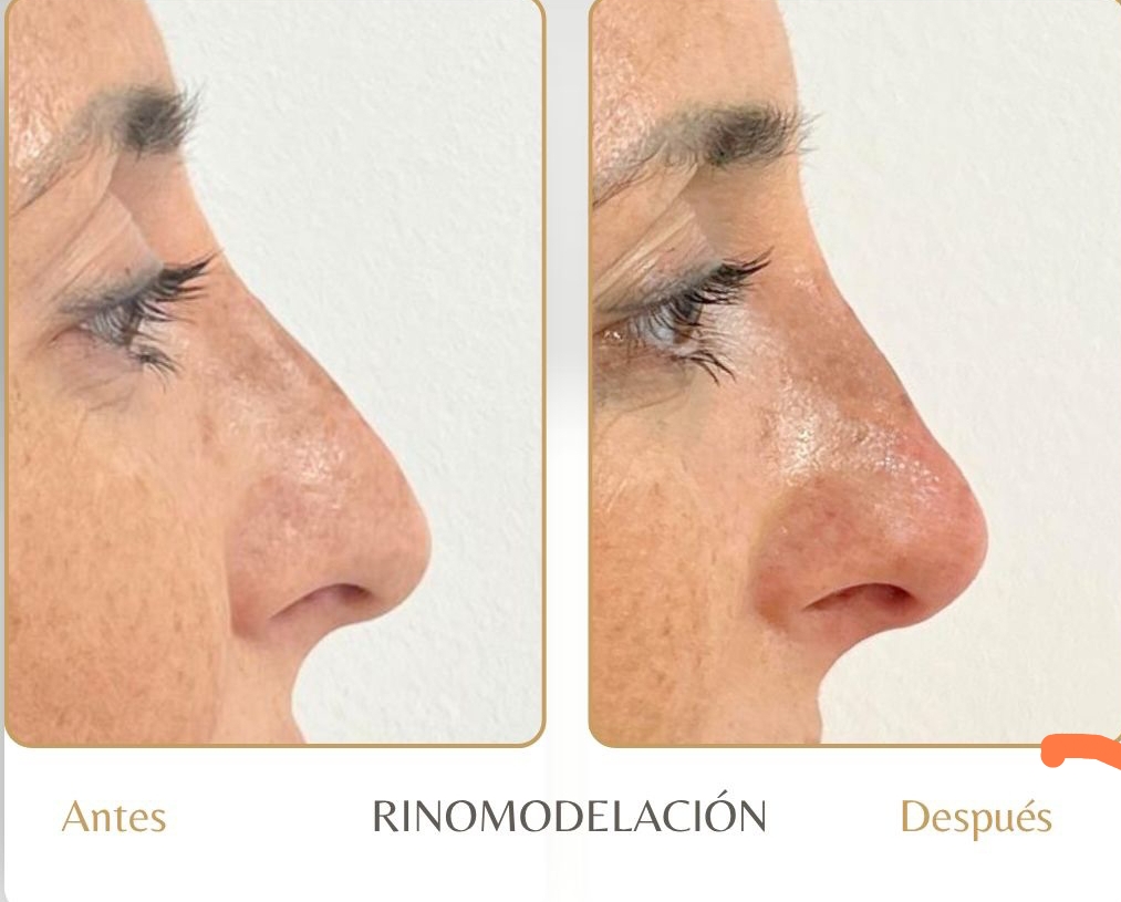 Antes/después rinomodelación
