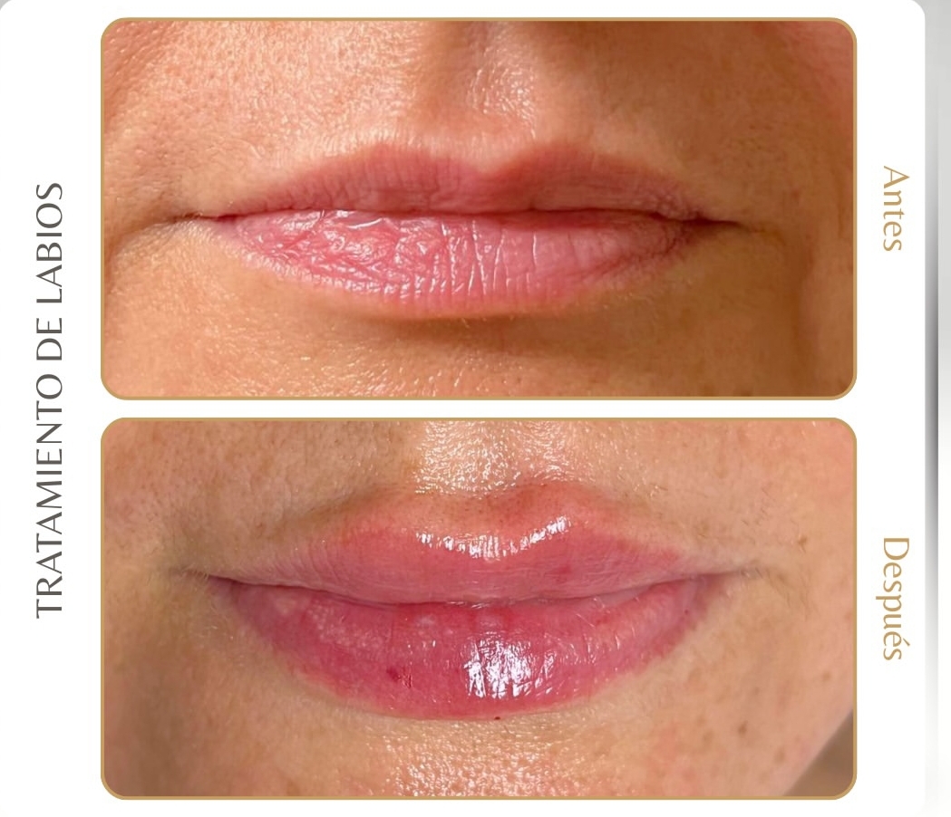 Antes/después labios mujer