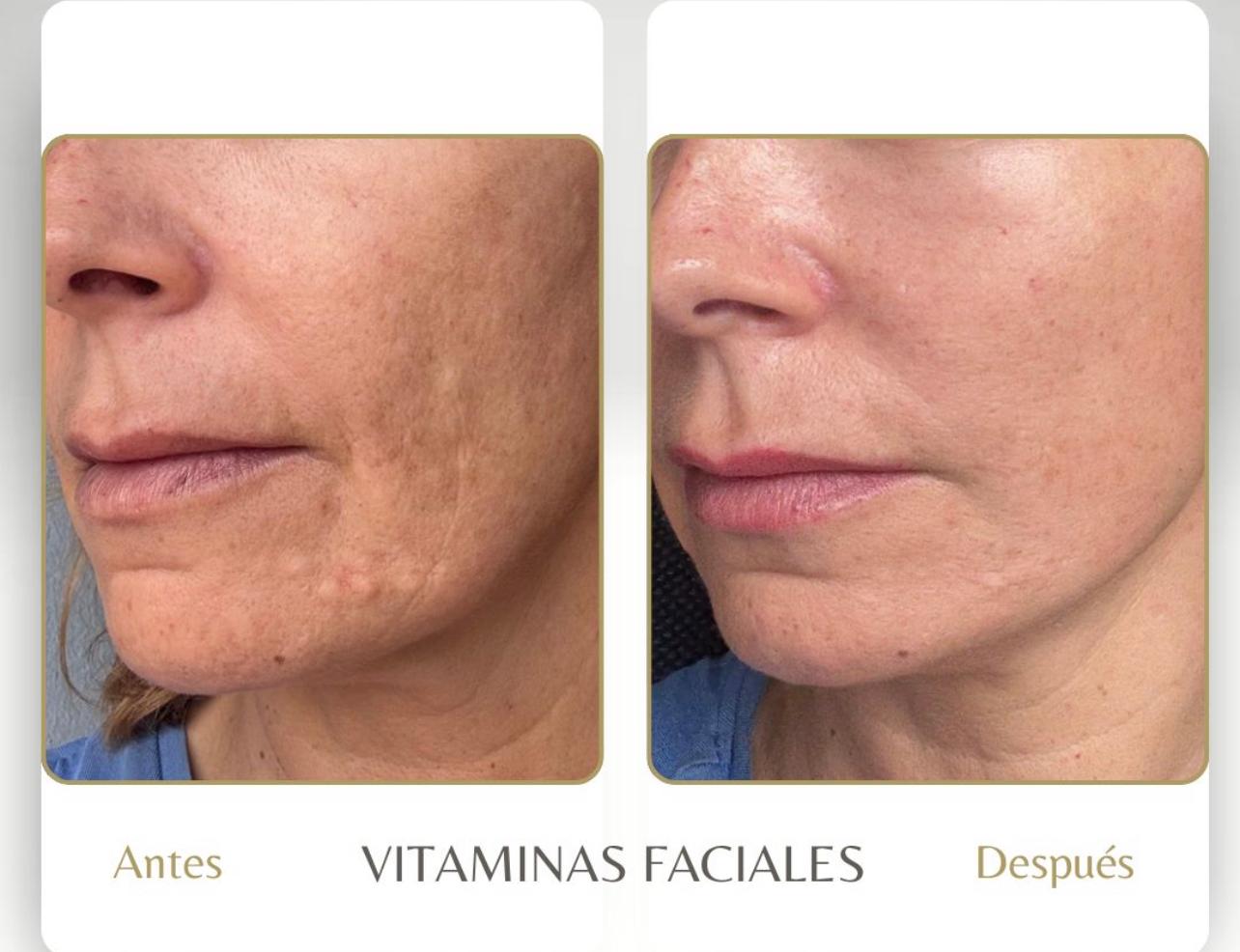 Antes/después Ana Sanchis